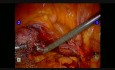 Robotic Colpopexy - Tips and tricks
