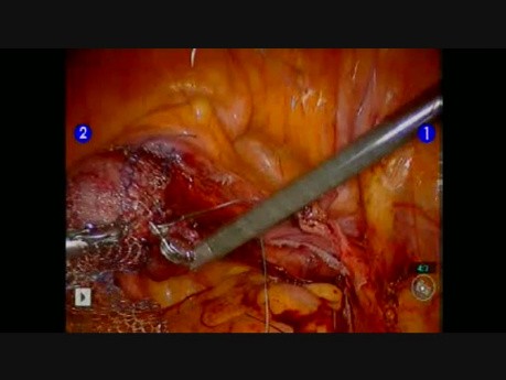 Robotic Colpopexy - Tips and tricks