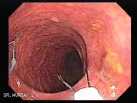 Huge Mass Of The Descending Colon (12 of 25)