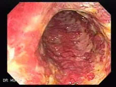 Multiple Rectal Ulcers (11 of 110)