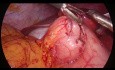 Laparoscopic Pyloroplasty - Heineke-Mikulicz