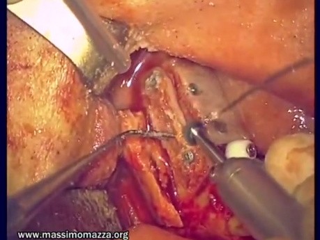 Regeneration Of Multialveolar Process (Left-Side) (1/3)