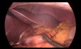 Gastric Sleeve to Gastric Bypass Conversion for GERD