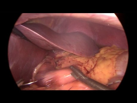 Gastric Sleeve to Gastric Bypass Conversion for GERD
