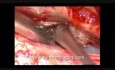 Spinal Cord Tumor - Spinal Intradural Meningioma - Microsurgical Excision