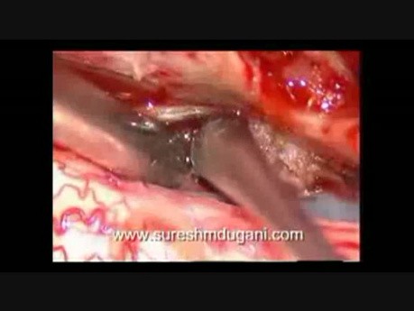 Spinal Cord Tumor - Spinal Intradural Meningioma - Microsurgical Excision