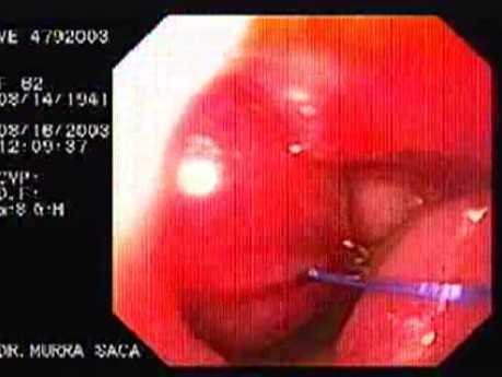 Intraluminal Endoscopic Suturing - Visualization of the Threads