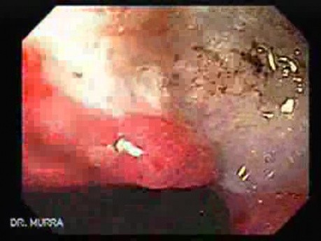 Two Ulcers in a Cirrhotic Patient - Giant Ulcer at the Lesser Curvature
