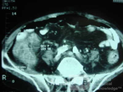 Pseudomembranous Colitis (11 of 11)