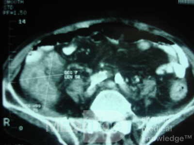 Pseudomembranous Colitis (11 of 11)