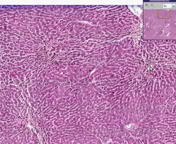 Liver - Chronic Passive Congestion With Hemorrhagic Centrilobular Necrosis