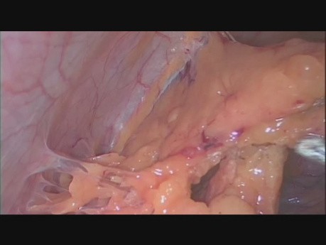 Total Laparoscopic Hysterectomy, Bilateral Aalpingooophorectomy, Peritoneal Washings and Omental Biopsy