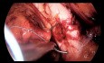 Preperitoneal Laparoscopic Lateral Repair in Pelvic Organ Prolapse – a Novel Approach