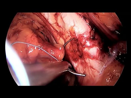 Preperitoneal Laparoscopic Lateral Repair in Pelvic Organ Prolapse – a Novel Approach