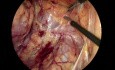Right Colectomy + D3 - The Step I of the Total Retromesenteric Approach