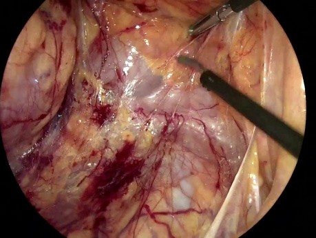 Right Colectomy + D3 - The Step I of the Total Retromesenteric Approach
