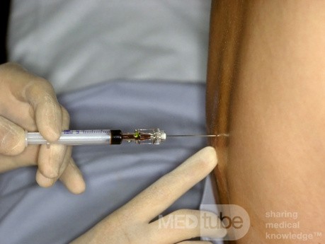 The Fluorescein Test for CSF Rhinorrhea