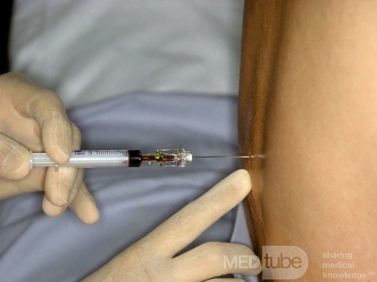 The Fluorescein Test for CSF Rhinorrhea