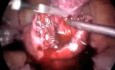 Miomectomy - Cystectomy