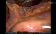 Robotic Right Colectomy with CME for Right-sided Colon Cancer