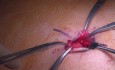 Pitfalls in Intragastric Surgery in the Treatment of Gastric Stromal Tumors