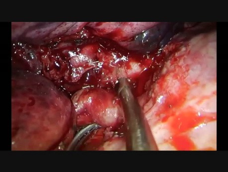 Huge Lung Cancer Right Upper Sleeve Lobectomy Operated by Uniportal VATS