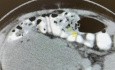 Huge Retroperitoneal Collection