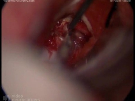 Craniopharyngioma - Right Pterional Approach With Pituitary Stalk Sparing