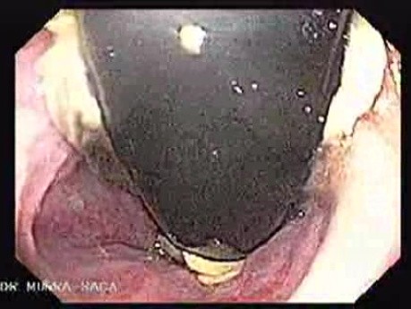 Endoscopic Variceal Ligation - Status Post Banding in Retroflexed View, Part 1