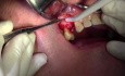 Flap Design & Pilot Hole - Implant Placement #5 - ID Screwplant System