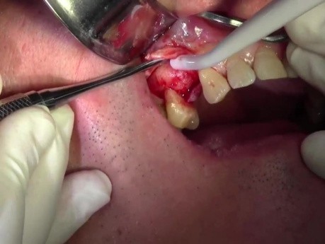 Flap Design & Pilot Hole - Implant Placement #5 - ID Screwplant System