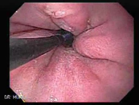 Endoscopic Baloon Dilation Of The Esophageal Stricture - Position Of The Inflated Baloon - 4/8
