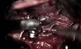 Brain Aneurysm Surgery Footage