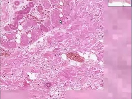 Dry gangrene