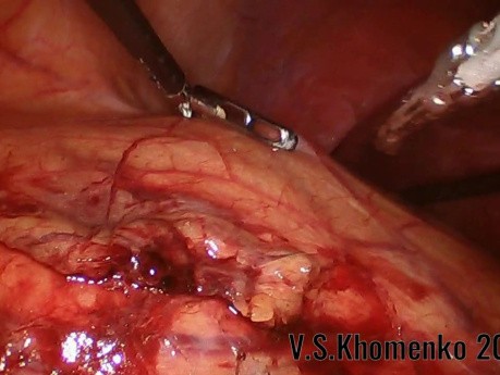 Kidney Carcinoma