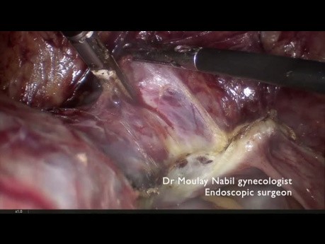 Challenging Hysterectomy. Huge Uterus and Preview C Scar Sections.