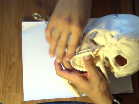 Mandible Fracture - Ivy Loop Table Top Maxilla
