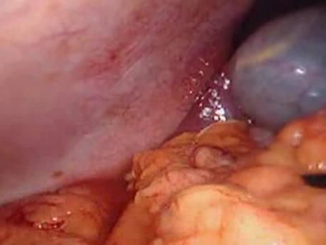 Colonic Perforation With Peritonitis - Laparoscopy (2 of 46)