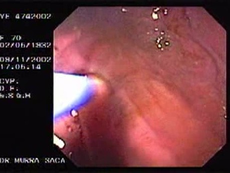 Dieulafoy´s Lesion (Exulceratio Simplex) (6 of 11)