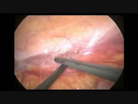 Laparoscopic Radical Nephrectomy In Kidney Cancer