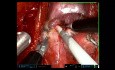 Remote Access Thyroid Surgery with Robot