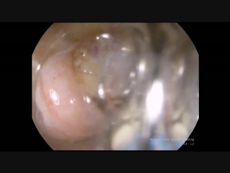 Endoscopic Submucosal Dissection of Duodenal Lipoma