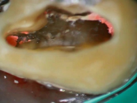 Guided detection of MB2 (CBCT)