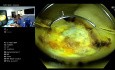 Delayed Bleeding Following Rectal LST Resection