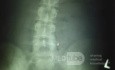 Ileus- Internal Hernia