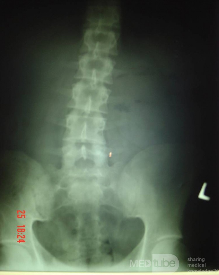 Ileus- Internal Hernia