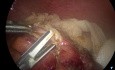 Laparoscopic Appendicectomy (Stapled) - Perforated Appendix