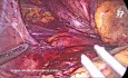 Large Hiatal Hernia Sac Dissection