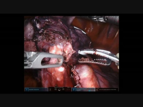 Anatomic Segmentectomy Lung Resection