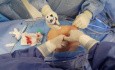 'Fail-Safe' First Abdominal Entry for Laparoscopic/Robotic Surgery ("Streaming Hollow-Entry")